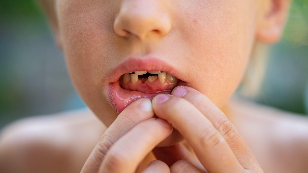 Tako pomagajte otroku, če si poškoduje zob