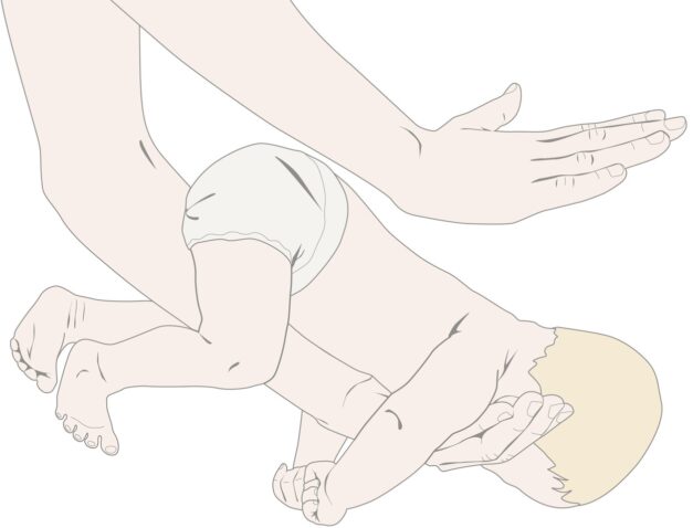 Heimlichov prijem pri dojenčku