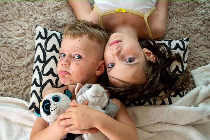 deček in deklica imata norice