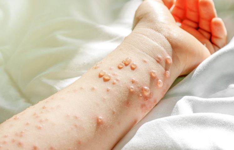 izpuščaj po rokah norice