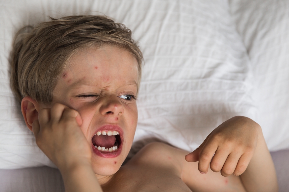 otrok, ki ima norice, se praska