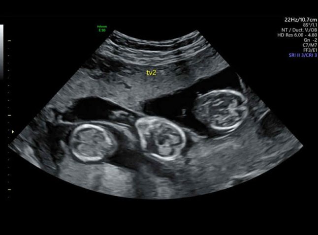 Ultrazvok. Foto: Profimedia