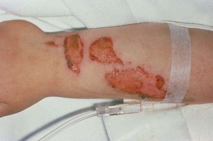 opekline na otrokovi roki